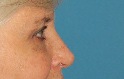 Upper Blepharoplasty Before & After Patient #3532