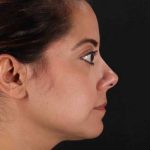 Buccal Fat Pad Before & After Patient #1436