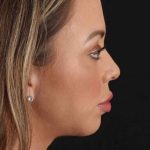 Buccal Fat Pad Before & After Patient #1447