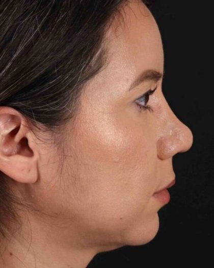 Buccal Fat Pad Before & After Patient #1458