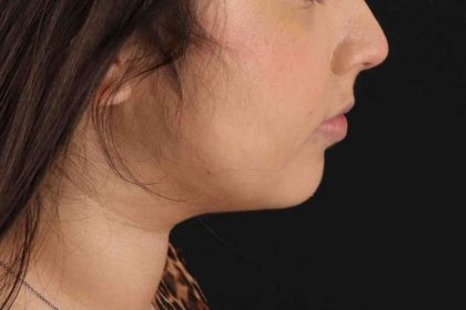 Buccal Fat Pad Before & After Patient #1469