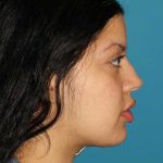 Buccal Fat Pad Before & After Patient #1485