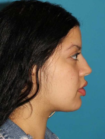 Buccal Fat Pad Before & After Patient #1485