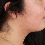 Chin Implant Before & After Patient #1529