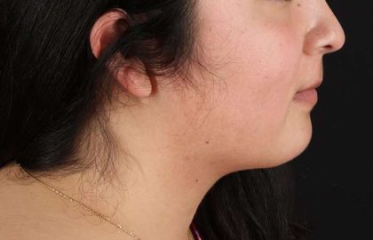 Chin Implant Before & After Patient #1529