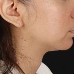 Chin Implant Before & After Patient #1540