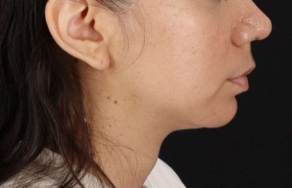 Chin Implant Before & After Patient #1540