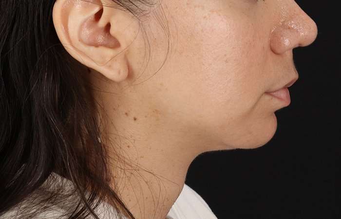 Chin Implant Before & After Patient #1540