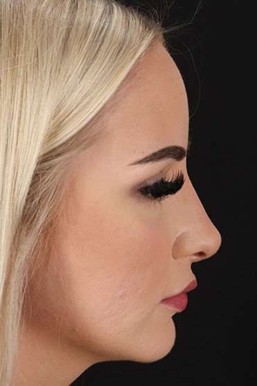 Browlift Before & After Patient #1242
