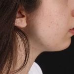 Chin Implant Before & After Patient #1551