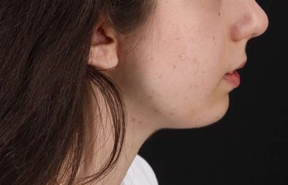 Chin Implant Before & After Patient #1551