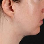 Chin Implant Before & After Patient #1562