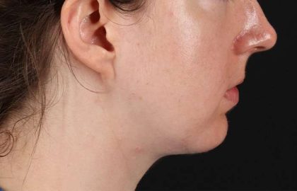 Chin Implant Before & After Patient #1562