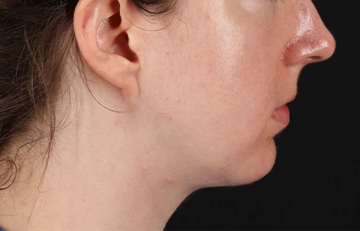 Chin Implant Before & After Patient #1562