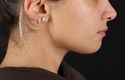 Chin Implant Before & After Patient #1573