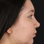 Chin Implant Before & After Patient #1604