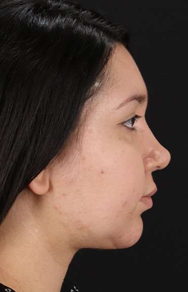 Chin Implant Before & After Patient #1604