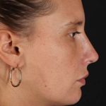 Chin Implant Before & After Patient #1615