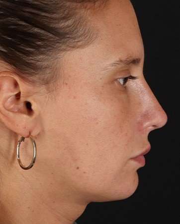 Chin Implant Before & After Patient #1615