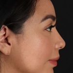 Chin Implant Before & After Patient #1626