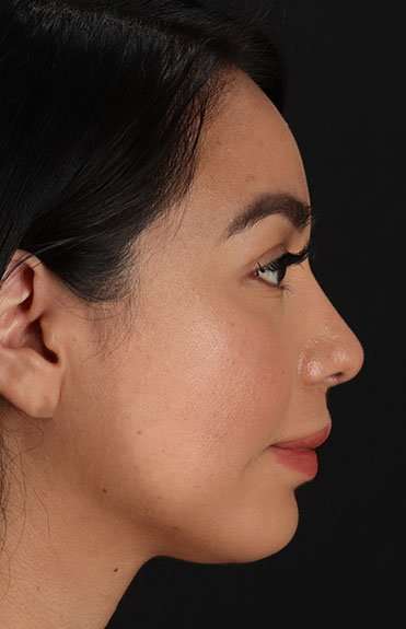 Chin Implant Before & After Patient #1626