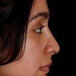 Chin Implant Before & After Patient #1637