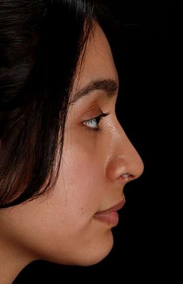 Chin Implant Before & After Patient #1637
