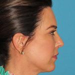Chin Implant Before & After Patient #1659