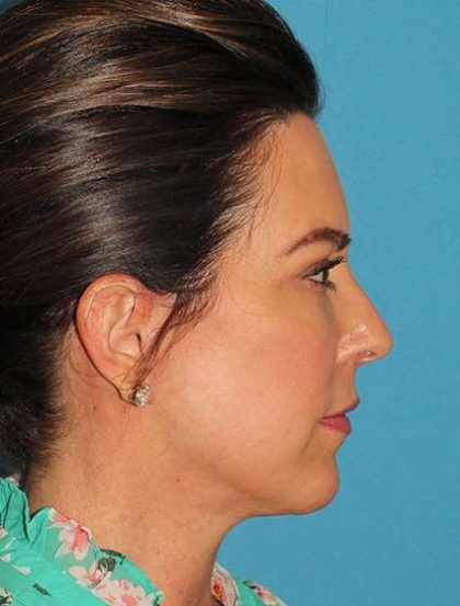 Chin Implant Before & After Patient #1659