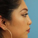 Chin Implant Before & After Patient #1670