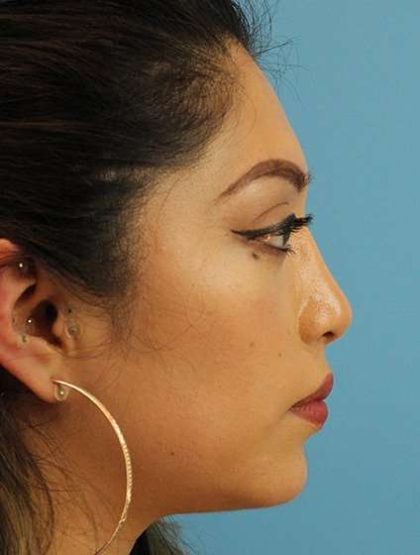 Chin Implant Before & After Patient #1670