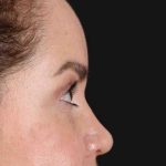 Browlift Before & After Patient #1253