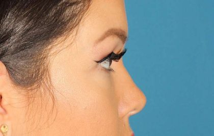 Eyelid Lift Before & After Patient #1729