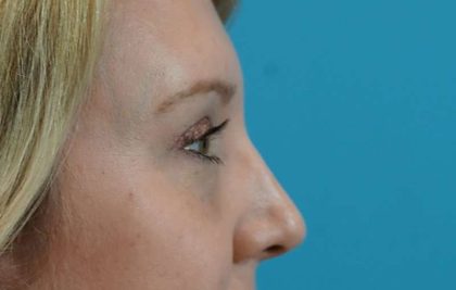 Eyelid Lift Before & After Patient #1747