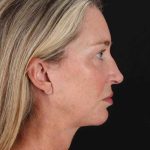 Facelift Before & After Patient #1778