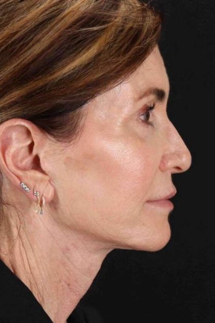 Facelift Before & After Patient #1789