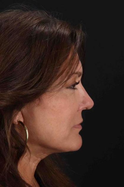 Facelift Before & After Patient #1800