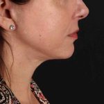 Facelift Before & After Patient #1809