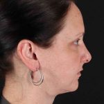 Facelift Before & After Patient #1843