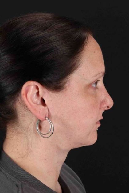 Facelift Before & After Patient #1843