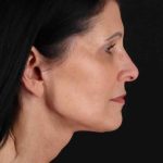 Facelift Before & After Patient #1854