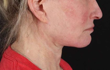 Facelift Before & After Patient #1866