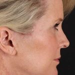 Facelift Before & After Patient #1877