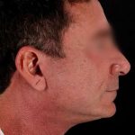 Facelift Before & After Patient #1899