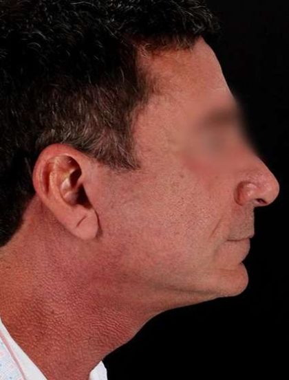 Facelift Before & After Patient #1899