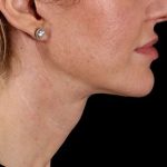 Facelift Before & After Patient #1921