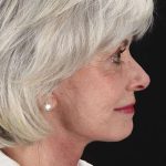 Facelift Before & After Patient #1932