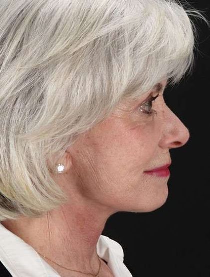 Facelift Before & After Patient #1932