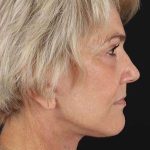Facelift Before & After Patient #1943