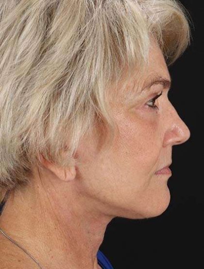 Facelift Before & After Patient #1943